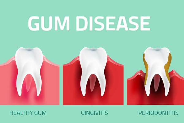 Gum Disease Treatment